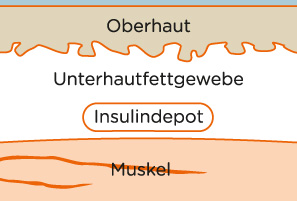 Platzierung des Insulindepot im Unterhautfettgewebe Platzierung des Insulindepot im Unterhautfettgewebe