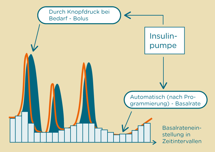 Insulinabgabe mit der Insulinpumpe
